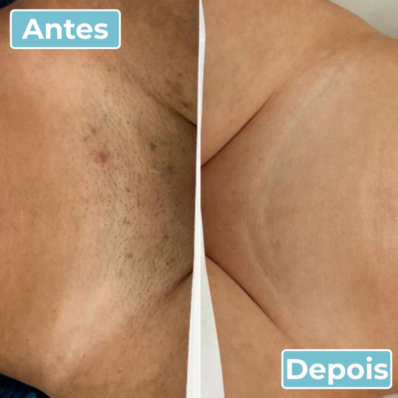 LisoPro™ - Obter uma pele suave em segundos