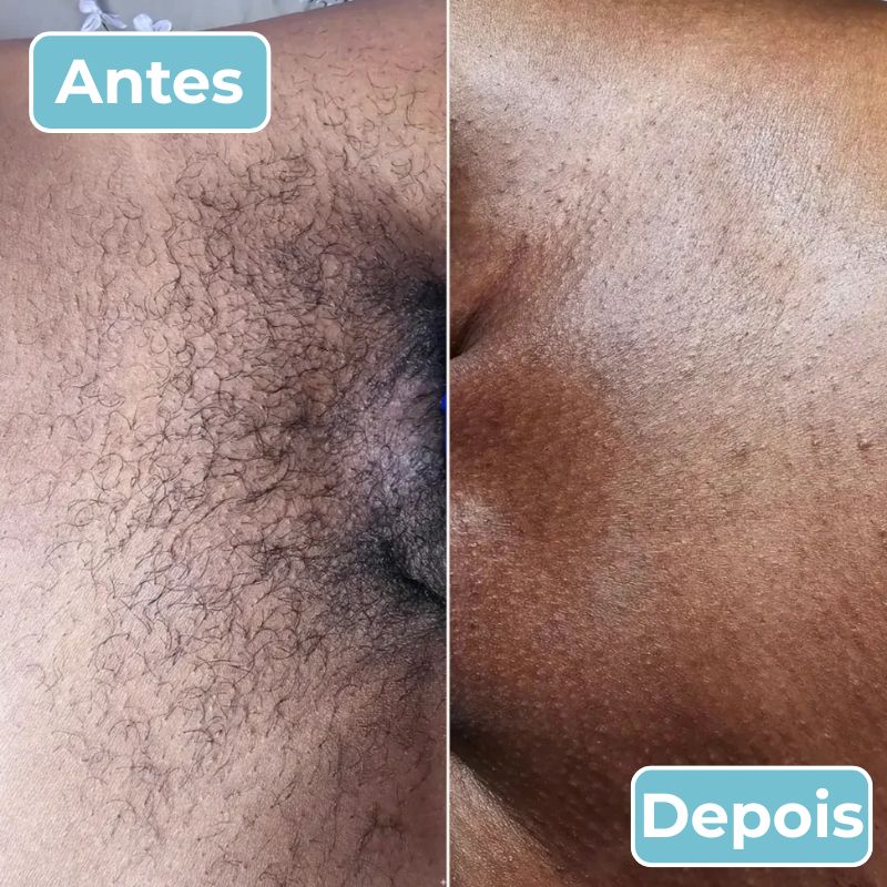 LisoPro™ - Obter uma pele suave em segundos