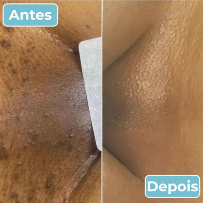 LisoPro™ - Obter uma pele suave em segundos